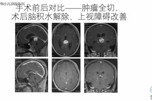 颅内肿瘤引起脑积水是不是都要做分流手术