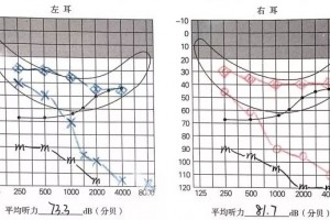 为什么我花了那么多钱选配助听器仍是听不清并且吵得难过