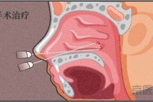 过敏性鼻炎能彻底治愈吗这篇文章总算说透了