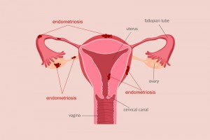 杭州菁华妇儿医院子宫内膜越轨可致不孕